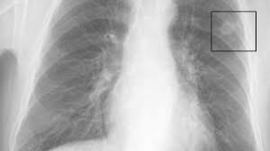 Comunicacin Silicosis en el Congreso europeo de la ERS