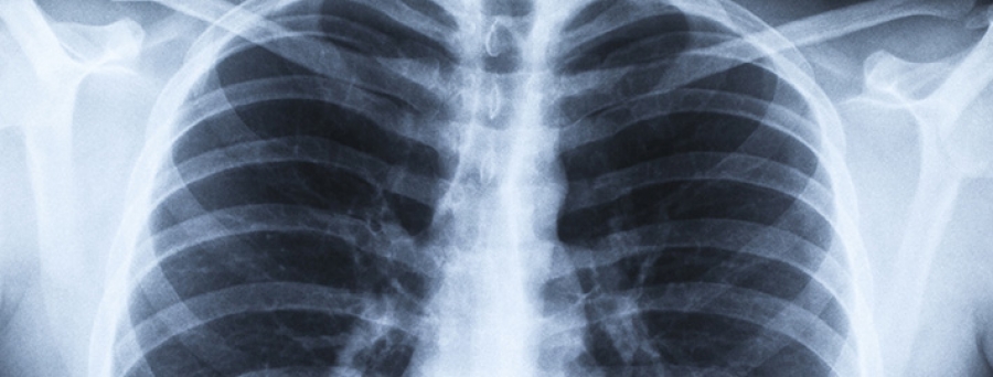 Biomarcadores de asbestosis y silicosis