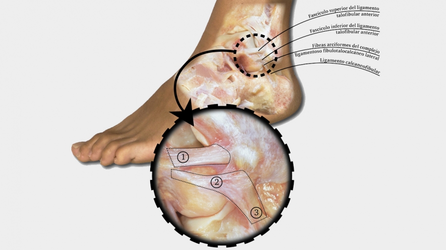 Describen un nuevo complejo ligamentoso en el tobillo: el fibulotalocalcneo lateral