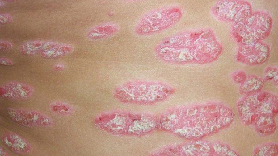 Papel del mdico del trabajo en la identificacin y reconocimiento oficial de las dermatosis profesionales 